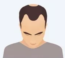 Stage 1