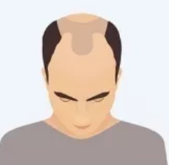 Stage 3